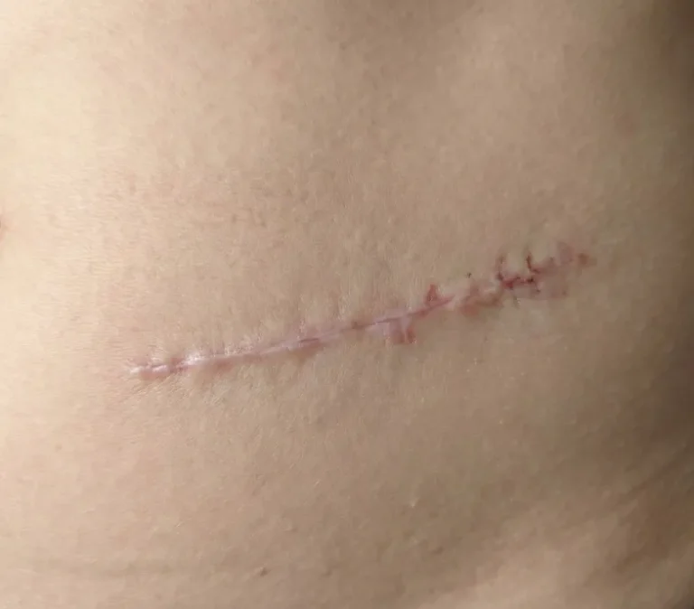 Blizny potrądzikowe, pooperacyjne i pourazowe