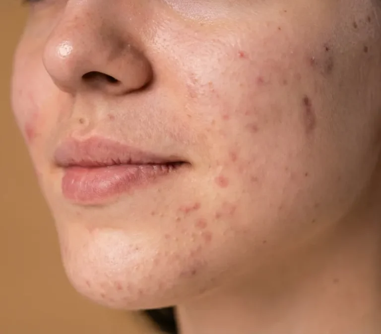 Skóra problematyczna i trądzik